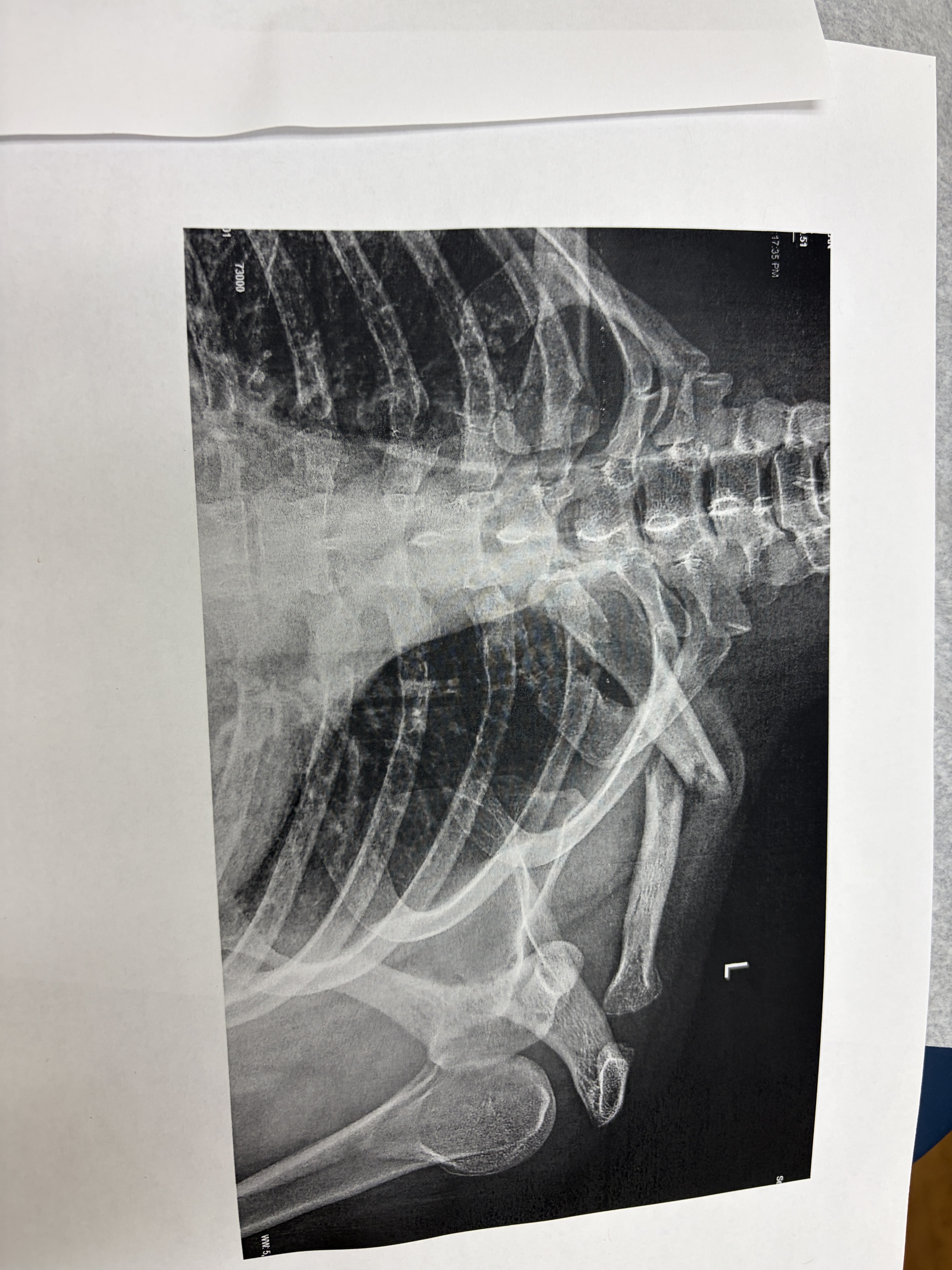 Clavicle X-Ray